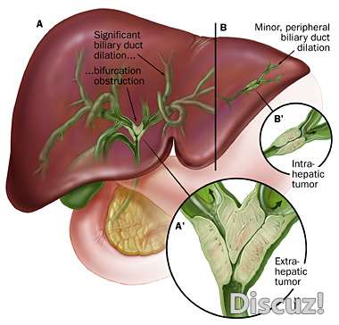 ICC in liver.jpg