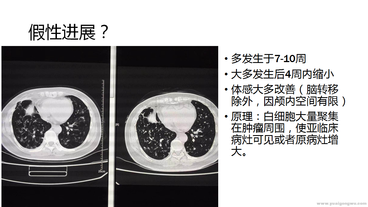 假性进展的经验