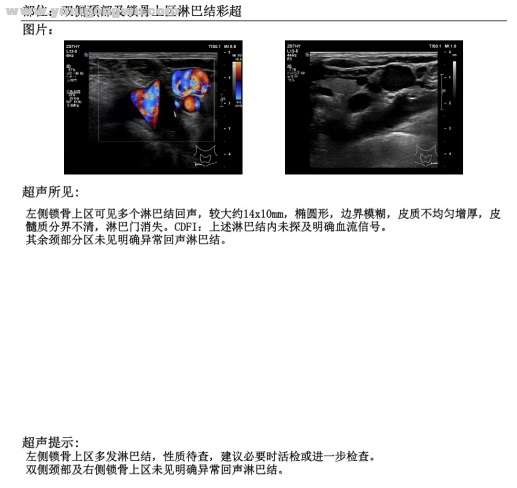 双侧颈部及锁骨上区淋巴结